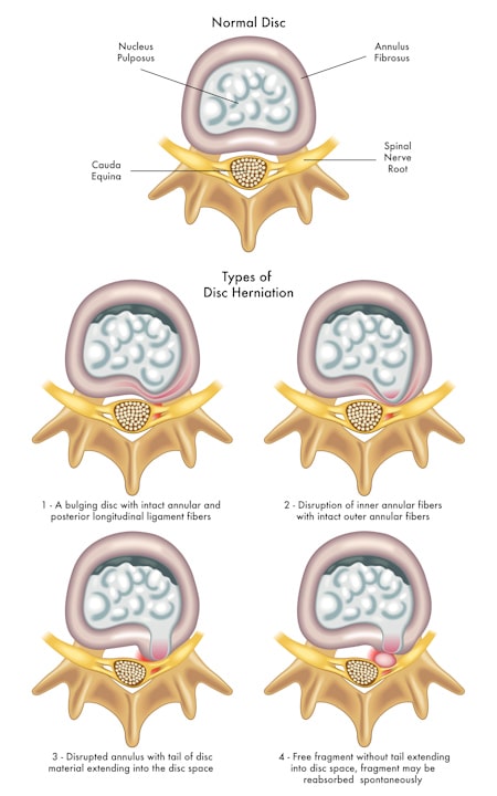 Chiropractic Peoria IL Herniated Disc